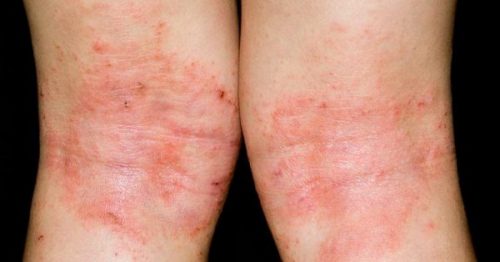 bieu hien benh eczema