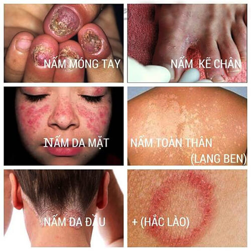 cac loai benh nam da