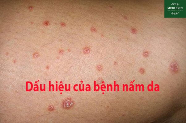 dau hieu cua benh nam da