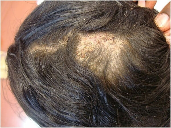 Nấm da đầu nặng gây ảnh hưởng tới sức khỏe người bệnh