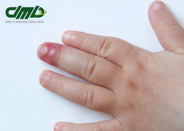 Bệnh nấm móng tay gây ra do nhiều nguyên nhân, ảnh hưởng trực tiếp đến tâm lý của trẻ