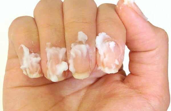 Cách sử dụng thuốc trị nấm móng tay Medi skin