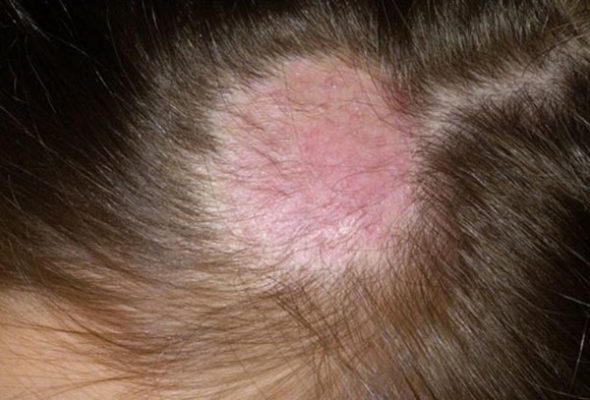 bị nấm da đầu có nên gội đầu nhiều không